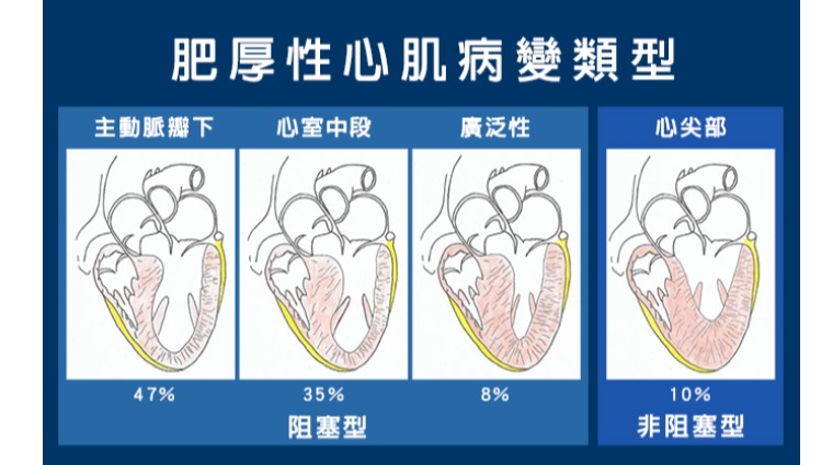 肥厚性心肌病變類型