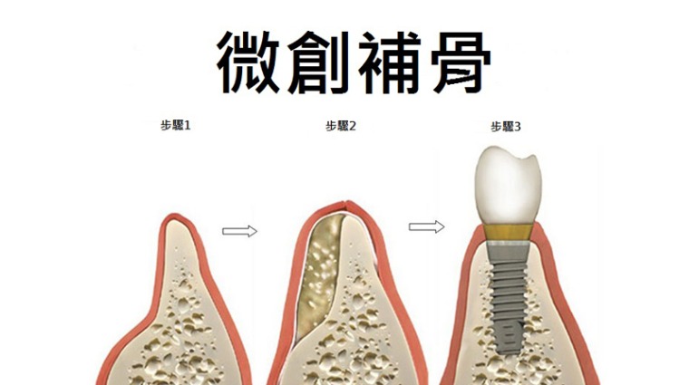 微創補骨