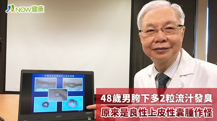 48歲男胯下多2粒流汁發臭 原來是良性上皮性囊腫作怪