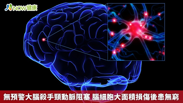 無預警大腦殺手頸動脈阻塞 腦細胞大面積損傷後患無窮