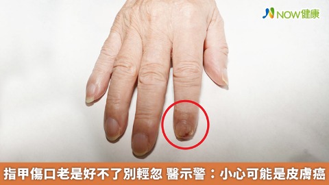 指甲傷口老是好不了別輕忽 醫示警：小心可能是皮膚癌