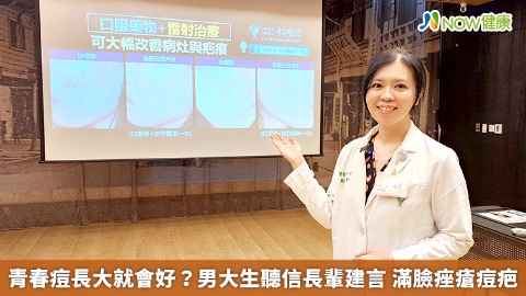 青春痘長大就會好？男大生聽信長輩建言 滿臉痤瘡痘疤