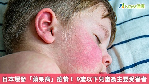 日本爆發「蘋果病」疫情！  9歲以下兒童為主要受害者