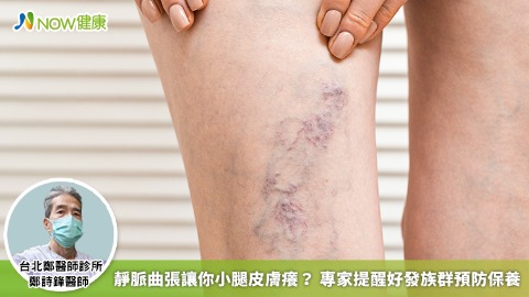 靜脈曲張讓你小腿皮膚癢？ 專家提醒好發族群預防保養