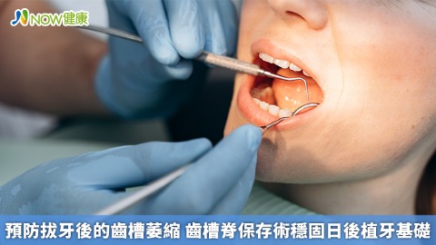 預防拔牙後的齒槽萎縮 齒槽脊保存術穩固日後植牙基礎
