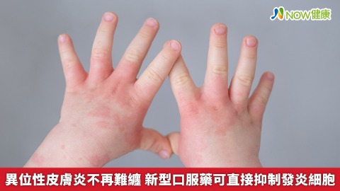 異位性皮膚炎不再難纏 新型口服藥可直接抑制發炎細胞