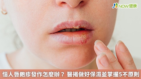 惱人唇皰疹發作怎麼辦？ 醫揭做好保濕並掌握5不原則