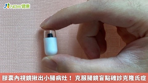 膠囊內視鏡揪出小腸病灶！ 克服腸鏡盲點確診克隆氏症