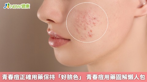 青春痘正確用藥保持「好臉色」 青春痘用藥圖解懶人包