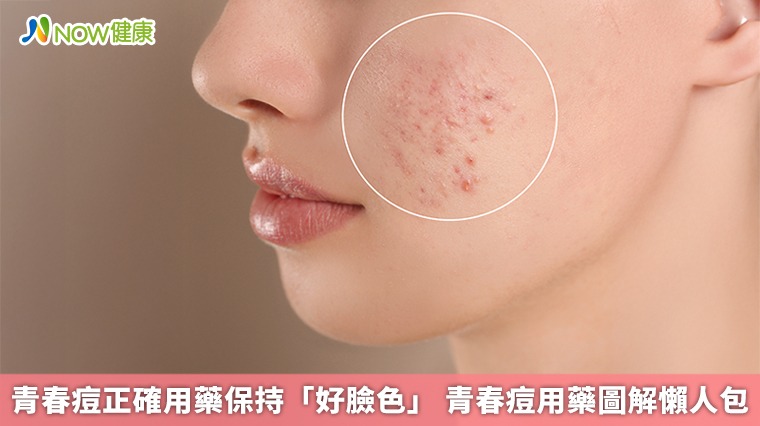 青春痘正確用藥保持「好臉色」 青春痘用藥圖解懶人包