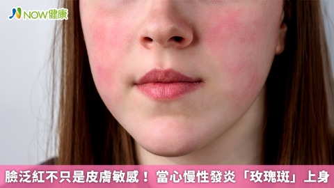 臉泛紅不只是皮膚敏感！ 當心慢性發炎「玫瑰斑」上身