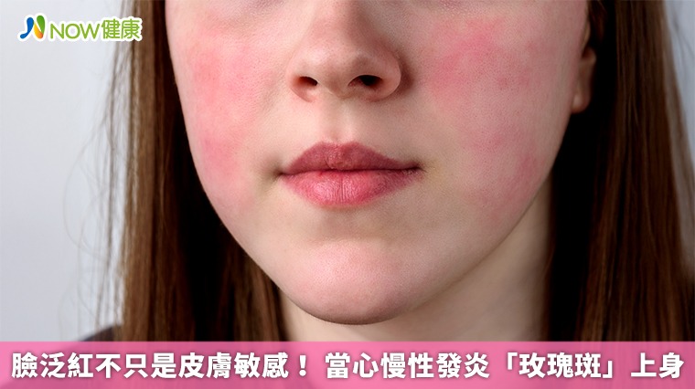臉泛紅不只是皮膚敏感！ 當心慢性發炎「玫瑰斑」上身