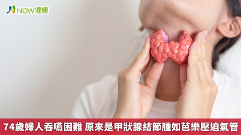 74歲婦人吞嚥困難 原來是甲狀腺結節腫如芭樂壓迫氣管