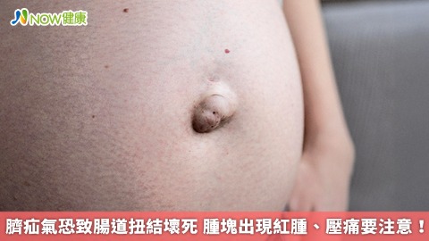 臍疝氣恐致腸道扭結壞死 腫塊出現紅腫、壓痛要注意！