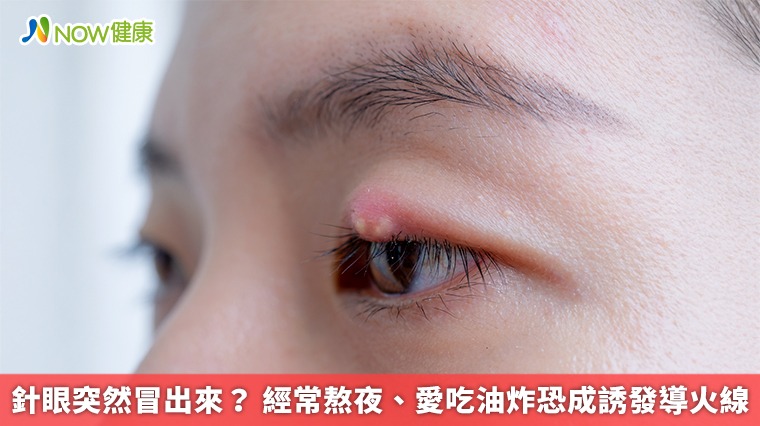 針眼突然冒出來？ 經常熬夜、愛吃油炸恐成誘發導火線