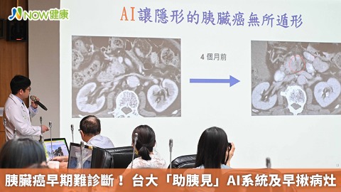 胰臟癌早期難診斷！ 台大「助胰見」AI系統及早揪病灶