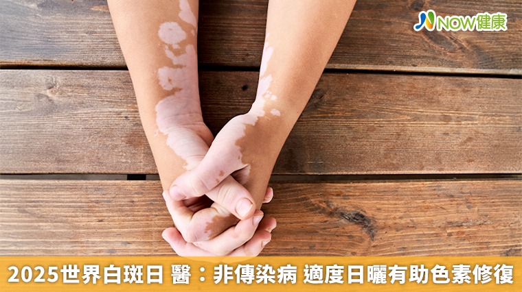 2025世界白斑日 醫：非傳染病 適度日曬有助色素修復
