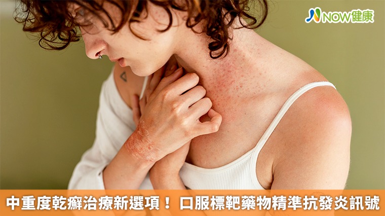 中重度乾癬治療新選項！ 口服標靶藥物精準抗發炎訊號