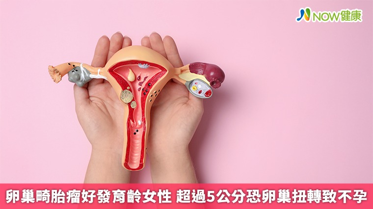 卵巢畸胎瘤好發育齡女性 超過5公分恐卵巢扭轉致不孕