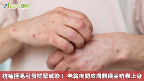 疥瘡極易引發群聚感染！ 老翁夜間皮膚劇癢竟疥蟲上身