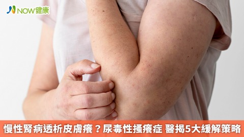 慢性腎病透析皮膚癢？尿毒性搔癢症 醫揭5大緩解策略