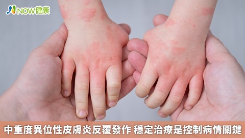 中重度異位性皮膚炎反覆發作 穩定治療是控制病情關鍵