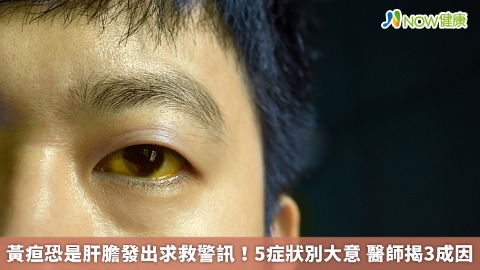 黃疸恐是肝膽發出求救警訊！5症狀別大意 醫師揭3成因