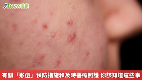 有關「猴痘」預防措施和及時醫療照護 你該知道這些事