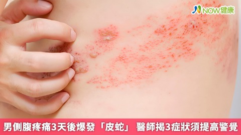 男側腹疼痛3天後爆發「皮蛇」 醫師揭3症狀須提高警覺