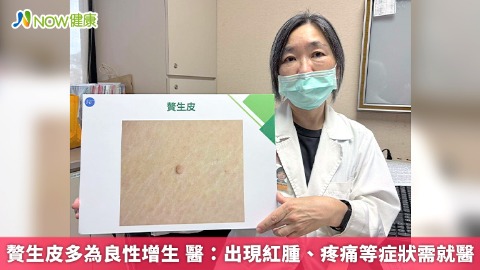 贅生皮多為良性增生 醫：出現紅腫、疼痛等症狀需就醫
