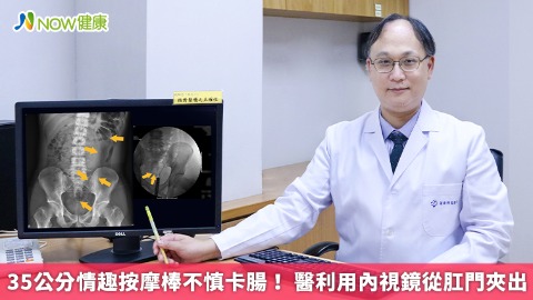 35公分情趣按摩棒不慎卡腸！ 醫利用內視鏡從肛門夾出