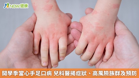 開學季當心手足口病 兒科醫揭症狀、高風險族群及預防
