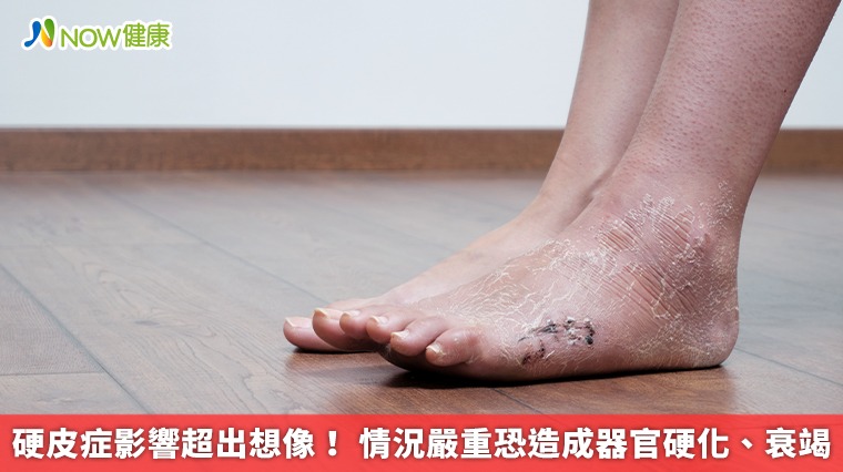 硬皮症影響超出想像！ 情況嚴重恐造成器官硬化、衰竭