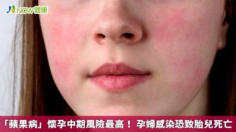 「蘋果病」懷孕中期風險最高！ 孕婦感染恐致胎兒死亡