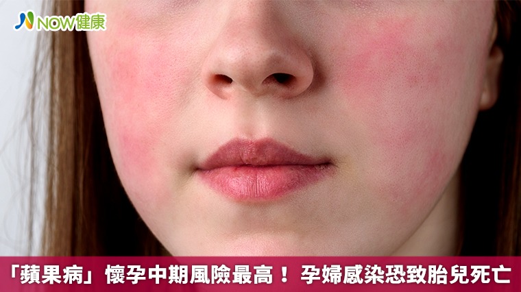 「蘋果病」懷孕中期風險最高！ 孕婦感染恐致胎兒死亡