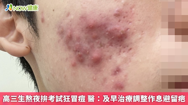 高三生熬夜拚考試狂冒痘 醫：及早治療調整作息避留疤