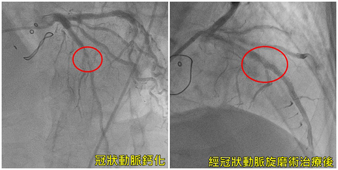 冠狀動脈旋磨術治療前後比較。（圖／亞洲大學附屬醫院提供）